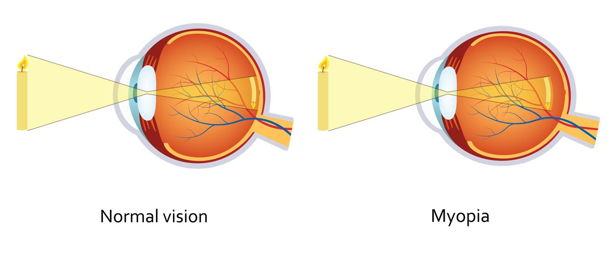 Myopia Control