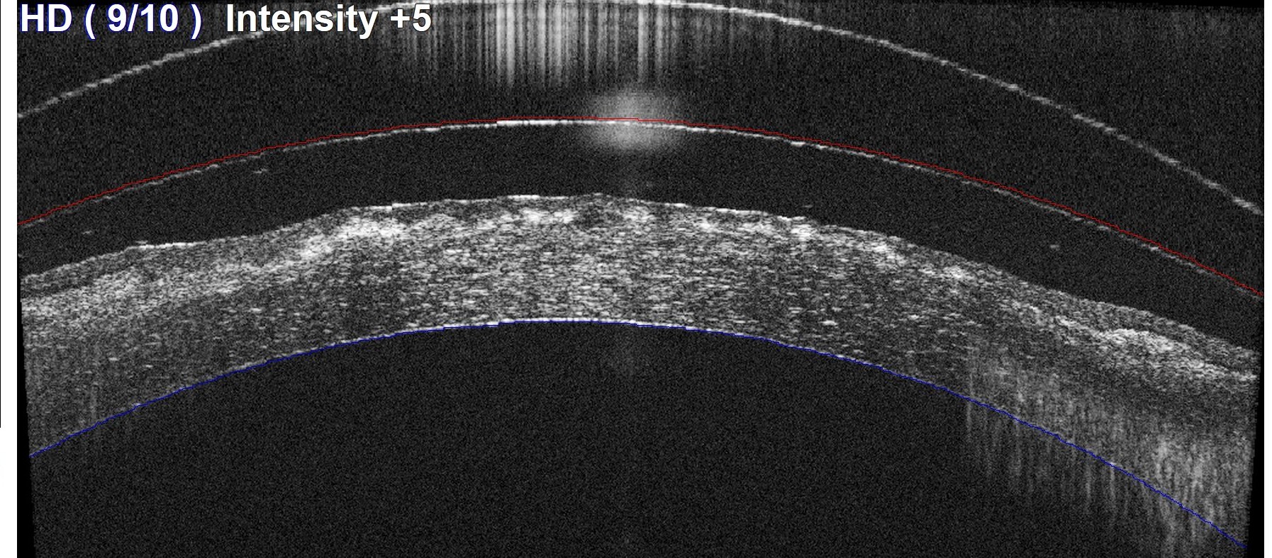 OCT scan of corneal dystrophy