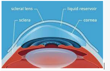 Cross-section diagram of an eye showing a scleral contact lens, with labeled parts including the sclera, cornea, and the liquid reservoir between the lens and cornea.