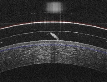 OCT scan showing protective tear reservoir in filamentary keratitis