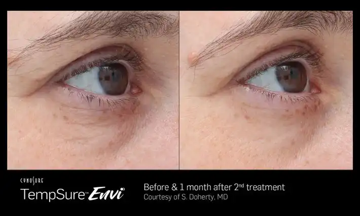 TempSure Evni Results